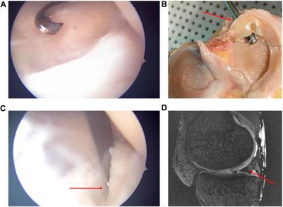 Extrusion and meniscal mobility evaluation in case of ramp lesion injury: a biomechanical feasibility study by 7T magnetic resonance imaging and digital volume correlation